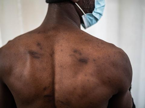 Le dos d'un jeune rescapé portant des cicatrices et des traces de torture. Il raconte avoir été incarcéré à plusieurs reprises dans des centres de détention en Libye et y avoir été torturé, notamment avec du courant électrique. Il raconte avoir pu s'en évader en étant laissé pour mort.